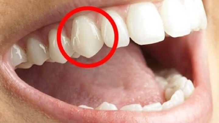 Riješila sam se pokvarenih zuba u 7 dana! Svako jutro i večer radila sam sljedeće