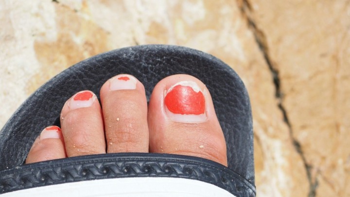 Imate tamne nokte na nogama? Evo o čemu je riječ i kako možete riješiti taj problem