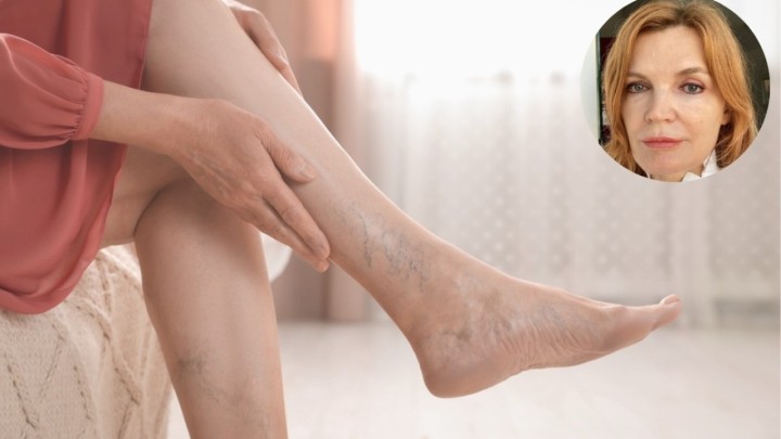 Proširene vene: Kako ih prepoznati, koliko su opasne i kako se tretiraju?