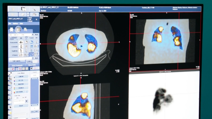 Hrvatska pomoću umjetne inteligencije dijagnosticira rak, evo kako to točno izgleda