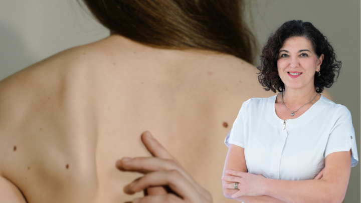 Dermatovenerologinja o važnosti pregleda madeža kod starijih: 'Imaju lošiju prognozu melanoma'